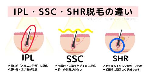 脱毛の種類IPL・SSC・SHR